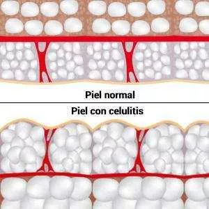 piel normal vs piel con celulitis